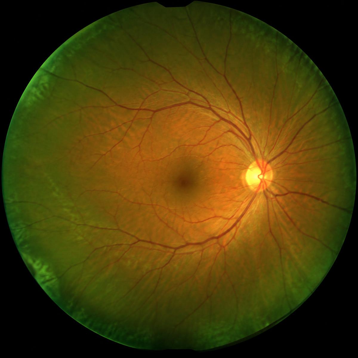 An Optomap ultra-widefield retinal image